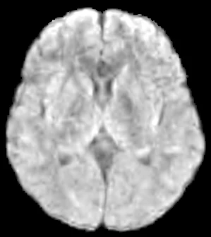 T2 FLAIR at 0.1 T