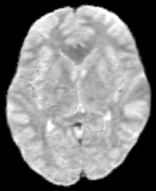 Acquired 0.1 T T2w slice