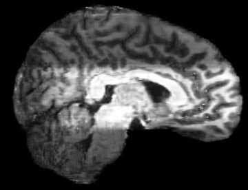 Sagittal reformat of CUT output showing heavy banding