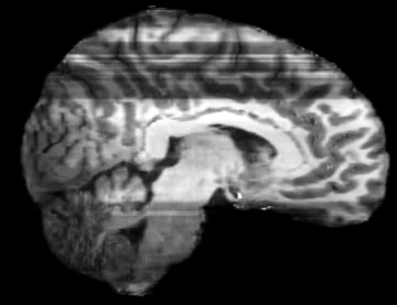 Sagittal reformat of CycleGAN output showing a block break
