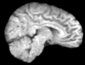 Sagittal reformat of the 0.1 T acquisition