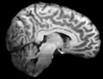 Sagittal reformat of FieldBridge output, nearly band-free