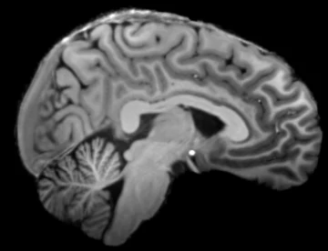 Sagittal view of the acquired 7 T